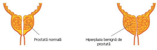 Hiperplazia benigna a prostatei: cauze, simptome, tratament